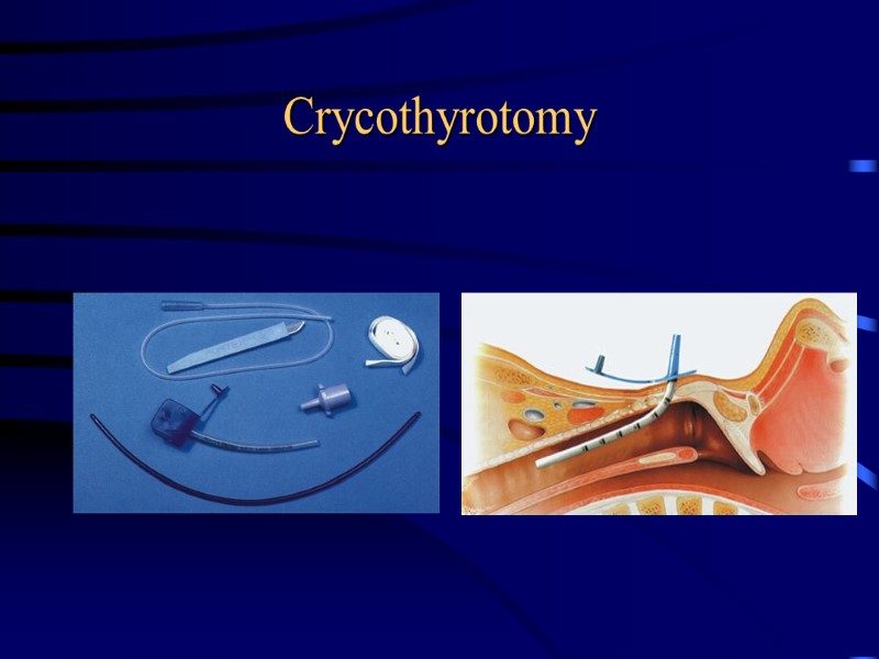Crycothyrotomy